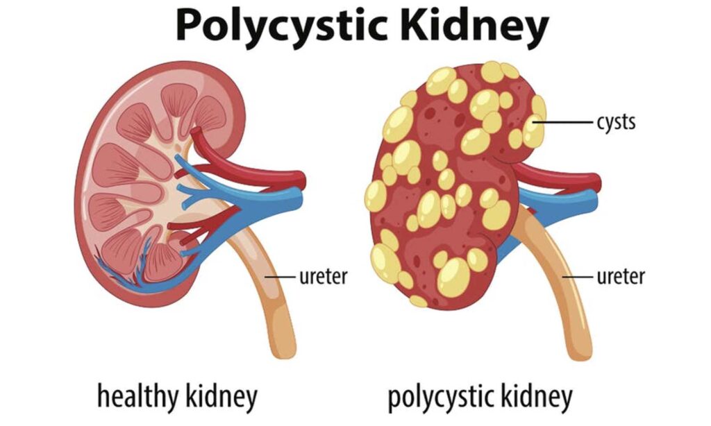 Polycystic-Kidney-Disease