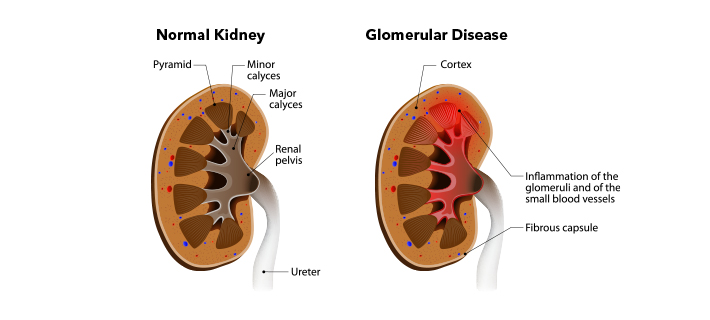 Glomerular-Disease-treatment